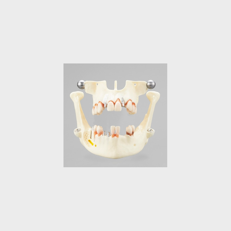 Implantat Studiemodel 
